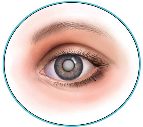 Cataract