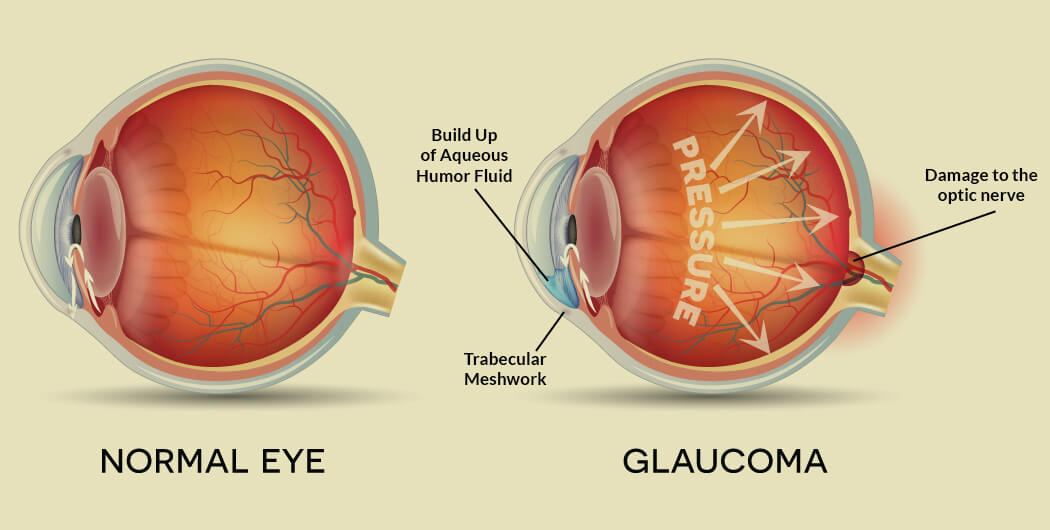 Visual impairment in&nbsp;glaucoma