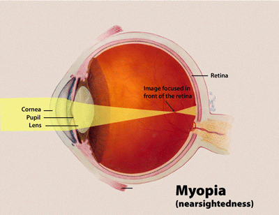 Near sightedness