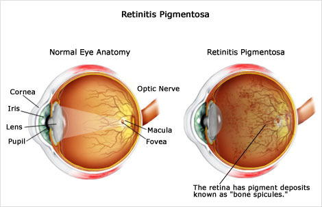 Retinitis Pigmentosa